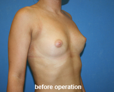 plastic-surgery-breast-augmentation